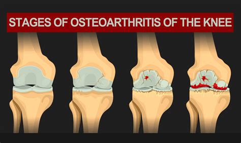 wear and tear test|osteoarthritis and wear and tear.